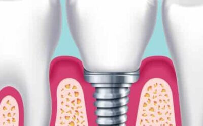 How to Choose an Implant Dentist: Everything You Need to Know
