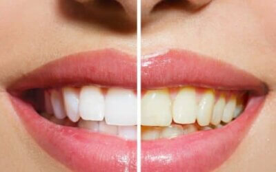 Cost and Benefits of Pro Teeth Whitening