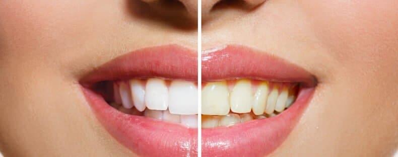 Cost and Benefits of Pro Teeth Whitening