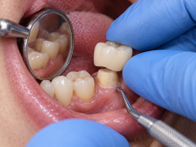 Dentist placing a temporary crown over a prepared back tooth.