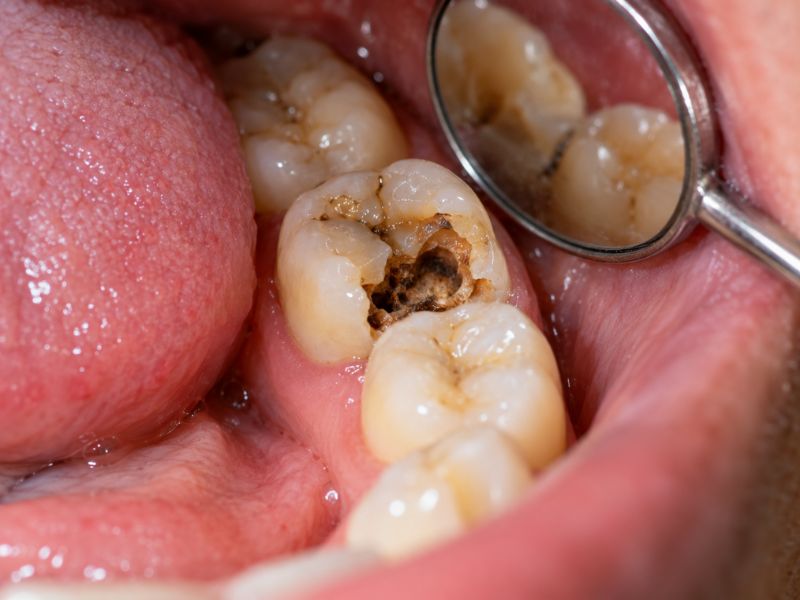 Close-up of a molar with a large cavity being examined with a dental mirror.