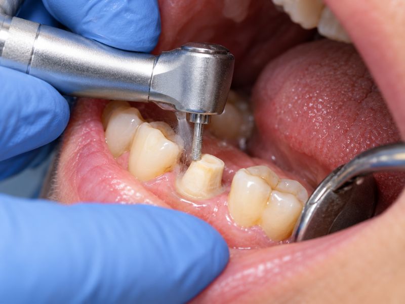 Dentist shaping a back tooth to prepare it for placement of a dental crown.